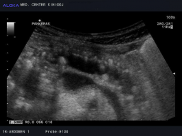 Ultrazvok trebušne slinavke - kronični kalcinirajoči pankreatitis, zgoraj razširjen pankreatični vod, spodaj vranična vena (v. lienalis) 2